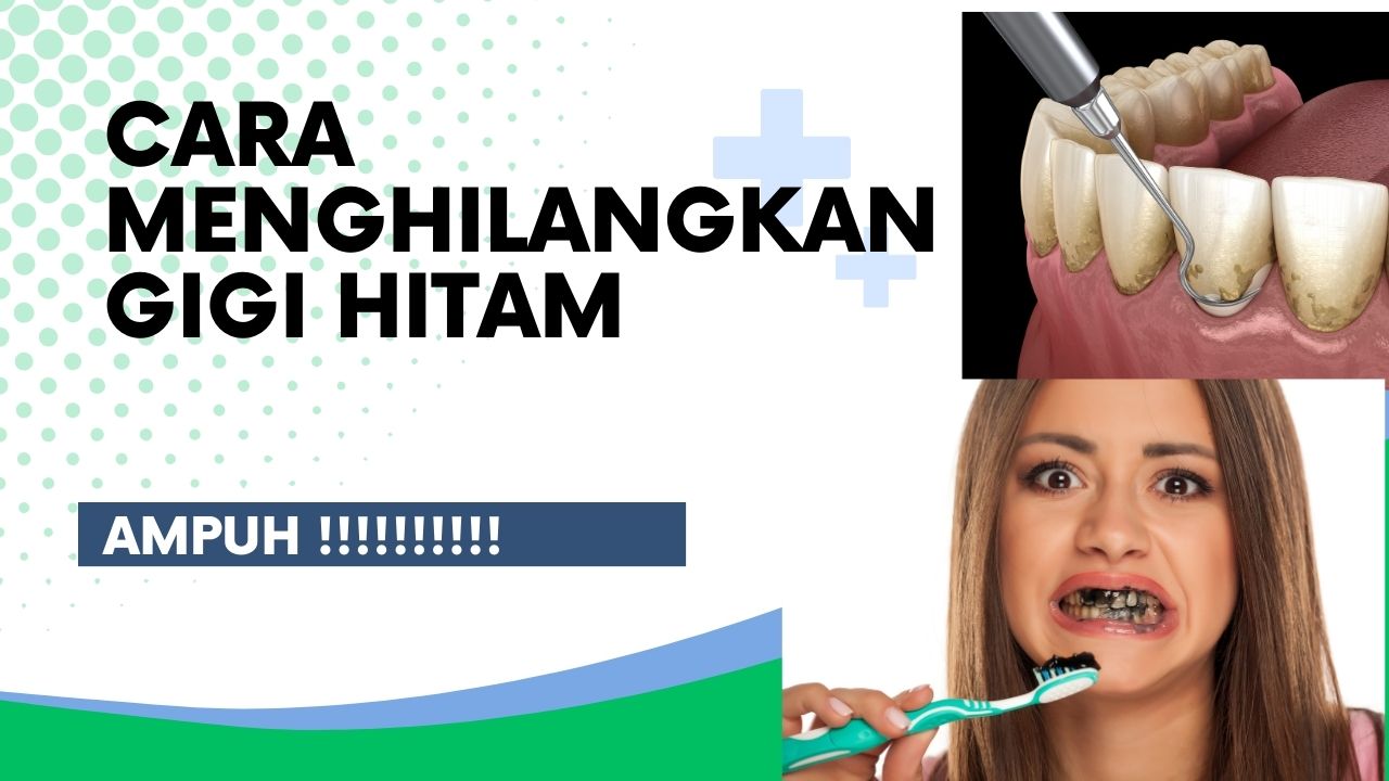 Cara Menghilangkan Gigi Hitam