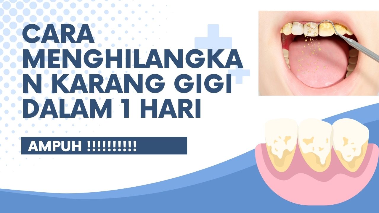 Cara Menghilangkan Karang Gigi Dalam 1 Hari